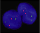In this micrograph, two interphase nuclei look like blue circles against a black background. Within each nucleus, there are two green spots, representing the two copies of chromosome 13, and three red spots, representing the three copies of chromosome 21.